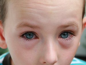 Аллергия глаз у детей