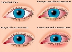Глазные противоаллергические капли