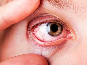 Описание и характеристика болезни эписклерит глаз