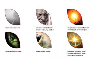 Изображение - Симптомы повышенного глазного давления у мужчин sindromy_zabolevaniya_sindromy