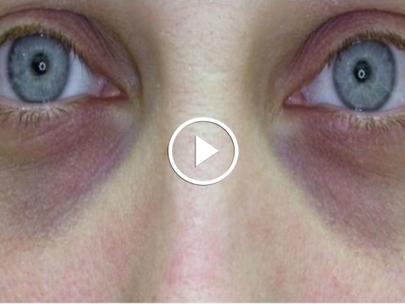 Мешки синие под глазами причины и лечение у женщин thumbnail