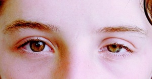 Причины развития миопатии глаз