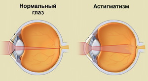 Заболевание глаз