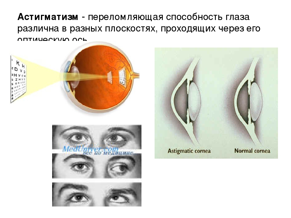 Что такое сложный миопический астигматизм. Астигматизм. Болезнь глаз астигматизм. Миопический астигматизм обоих глаз. Астигматизм глаз у взрослых.