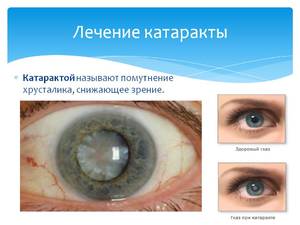 Какими методами лечат катаракту