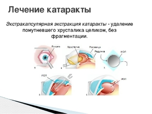 Методы лечения катаракты