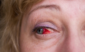 Причины кровоизлияния глаз
