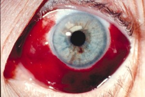 Травмы глаз
