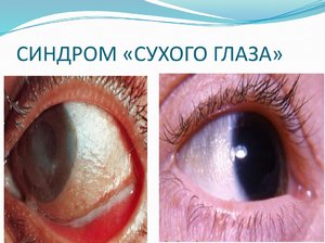 Диагностика сухого глаза