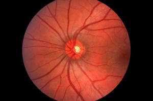 Классификация атрофии глазного нерва