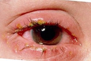 Причины демодекоза глаз