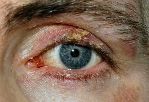 Симптомы проявления блефарита глаз и век