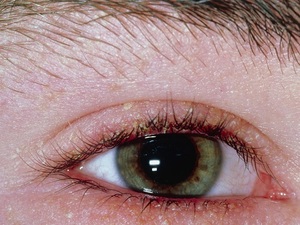 Особенности лечения блефарита век и глаз