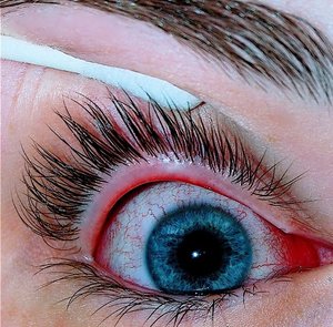 Лечение покраснения глаза