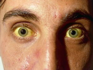 Причины жёлтых белков глаз