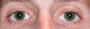  Анизокория глаз