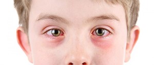 Красный глаз у ребенка