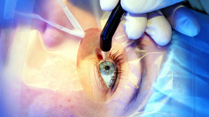 Описание метода удаления пингвекулы глаз лазером
