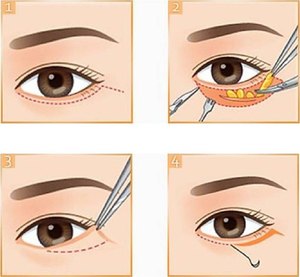 Птеригиум глаза - как проводят операцию (схема лечения)