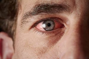 Способы лечения воспаления глаз от сварки