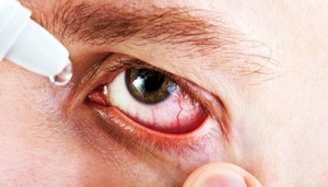 Медикаментозное лечение ожогов глаз от сварки