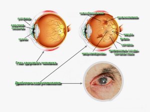 Проявления фоновой ретинопатии
