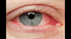 Симптоматика опухоли глаза