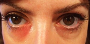 Причины красных пятен под глазами