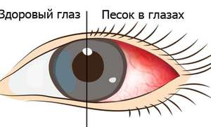 Методы лечения сухости глаза