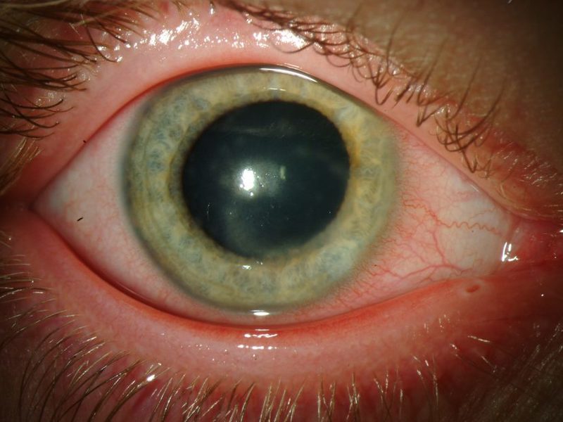 Светобоязнь глаз: причины, симптомы, лечение